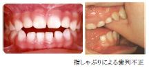 小児期の顎ずれの原因