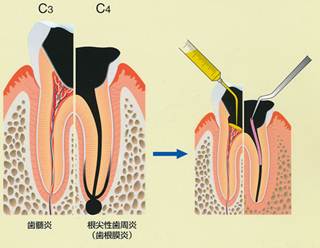 歯内療法